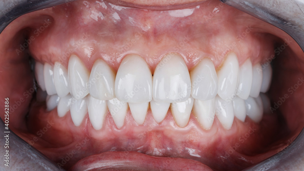beautiful teeth with ceramic veneers in bite