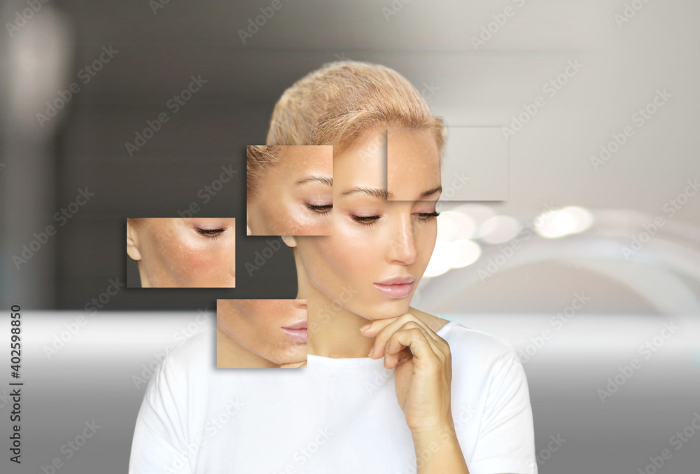 Dark spots, freckles,hyperpigmentation(melasma or chloasma),concept - skin lightening, skin whitening, fruit acids,AHA, Skin Brightening. Dark spots, freckles,hyperpigmentation(melasma or chloasma),concept - skin lightening, skin whitening, fruit acids,AHA, Skin Brightening.
