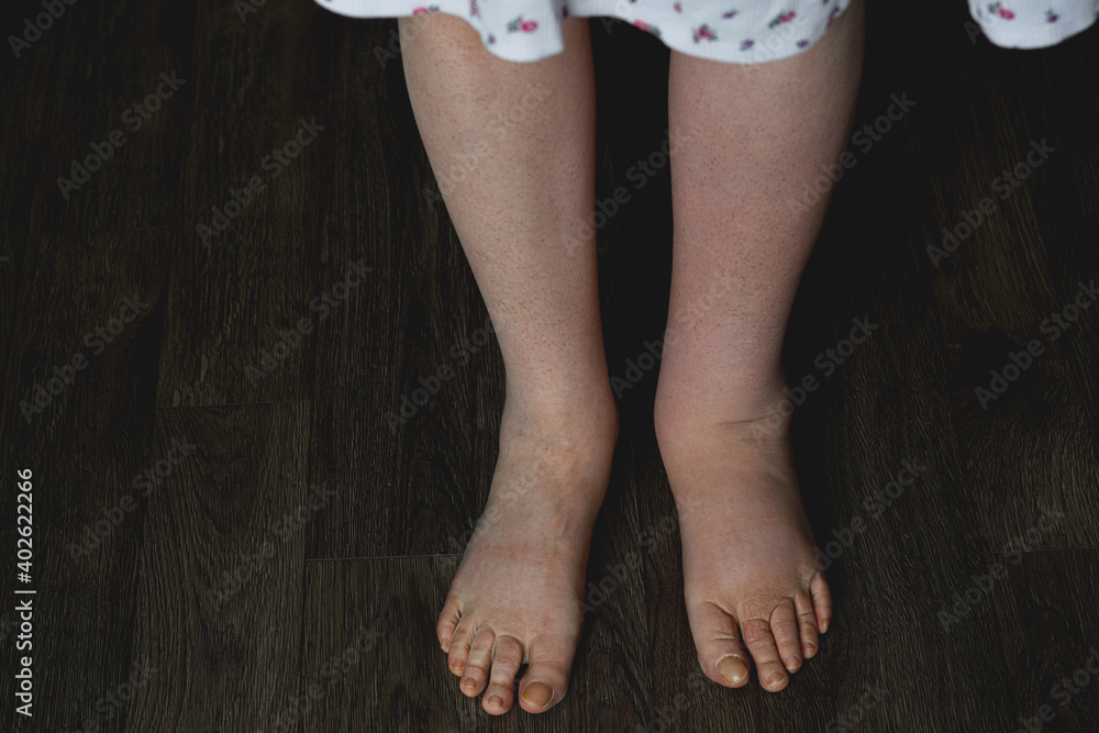 Swollen woman's feet with lymphedema condition Stock Photo Adobe Stock