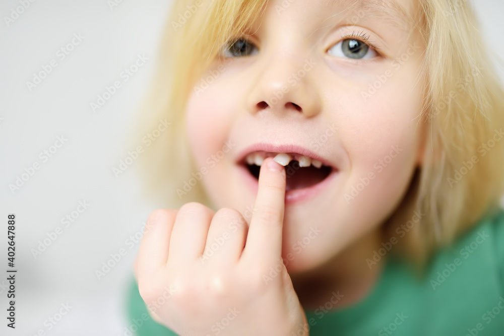 Portrait of boy shaking wobbly milk tooth in open mouth before it changes to the molar. Stages of growing up a child. Health care and dental hygiene for baby. Portrait of boy shaking wobbly milk tooth in open mouth before it changes to the molar. Stages of growing up a child. Health care and dental hygiene for baby.