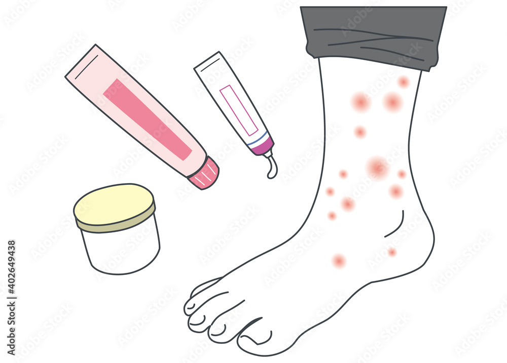 56 BEST 水疱瘡 IMAGES, STOCK PHOTOS u0026 VECTORS  Adobe 