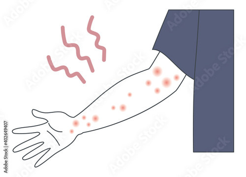 アトピー・蕁麻疹・帯状疱疹・湿疹ができた腕のイラスト