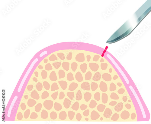 インプラント治療切開手術イラスト