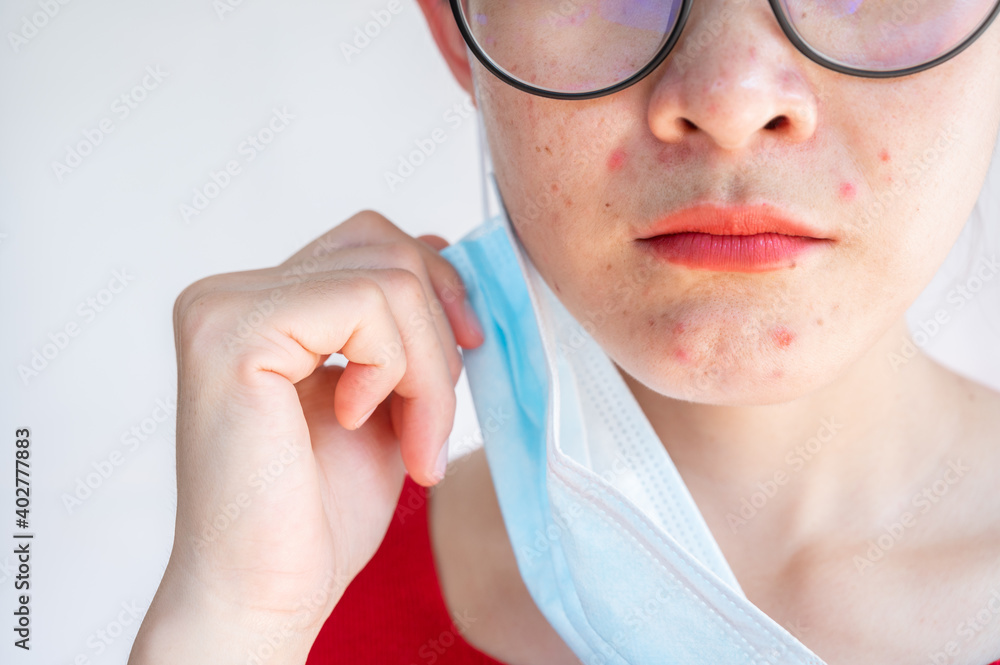 Cropped shot of acne Inflamed occur on woman face after wearing mask