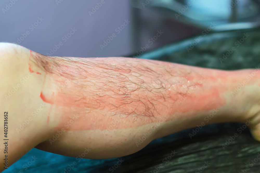 Fototapeta premium Hot, pink wax is applied to a woman's hairy leg. Hair removal on the legs in a beauty salon. Waxing. The concept of beauty, body care. Selective focus.