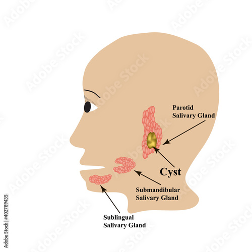 Parotid salivary gland. Submandibular salivary gland. Sublingual salivary gland. cyst. Vector illustration on isolated background