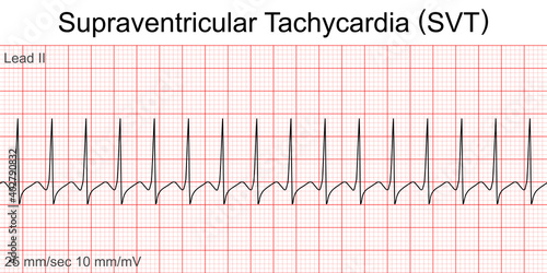 Electrocardiogram show Supraventricular tachycardia (SVT) pattern. Cardiac fibrillation. Heart beat.ECG. EKG.Vital sign.Medical healthcare symbol.