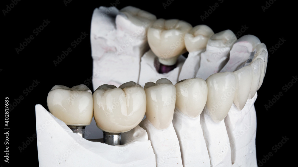 Obraz premium beautiful dental crowns and ceramic veneers on the model, filmed on a black background