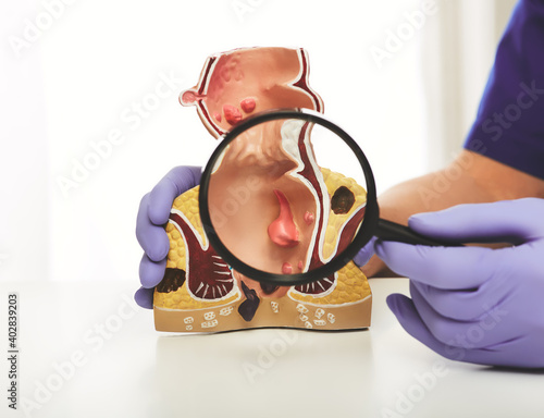 Proctologist with a magnifying glass in his hand showing rectum pathologies on an anatomical model. Treatment of rectal diseases, hemorrhoid