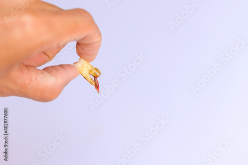 Tableau sur toile Extraction of an inflamed tooth with an abscess in the tooth