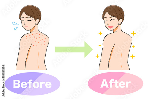 背中にきび　悩むビフォーアフター男性　イラスト