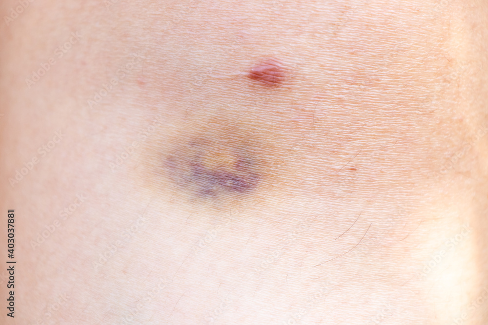 Closed up background of violet lesion on asian woman skin