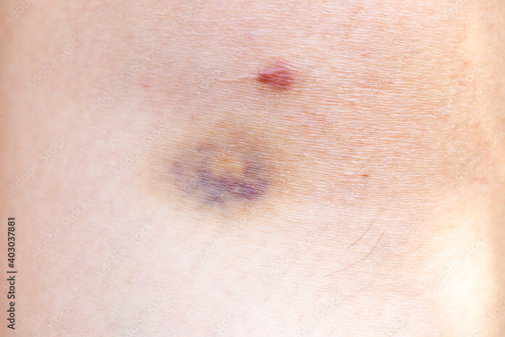 Fototapeta premium Closed up background of violet lesion on asian woman skin