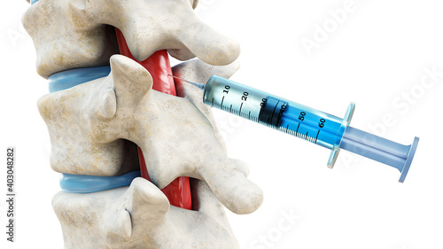 Syringe in the spinal cord isolated on a white background. Backbone or spinal column treatment with epidural injection 3D rendering illustration. Medical and healthcare, anatomy, medicine concept. photo