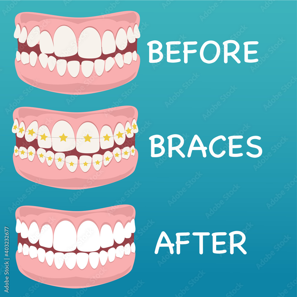 Stages of teeth alignment, before and after correction with brackets