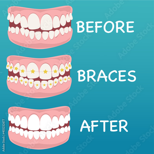 Stages of teeth alignment, before and after correction with brackets.Correction of teeth with orthodontic braces. Orthodontic dentistry. The alignment of the teeth. Healthy lifestyle and dental care
