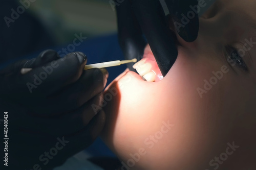 Doctor hygienist applying fluoride to teen teeth with cotton swab in dentistry. Covering using fluoride gel. Cure concept. Dentist making fluoridation child boy teeth after cleaning for protection. photo