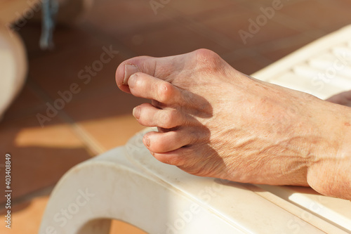 Severe bunion, also known as hallux valgus on foot of female senior resting on sunbed, closeup detail photo