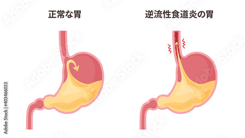 逆流性食道炎の胃と胃酸のイラスト photo