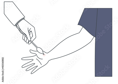 手にできたイボを治療するイラスト