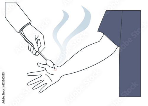 手にできたイボを液体窒素で治療するイラスト