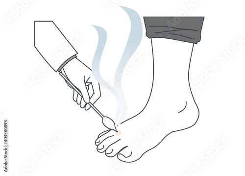 足にできたイボを液体窒素で治療するイラスト