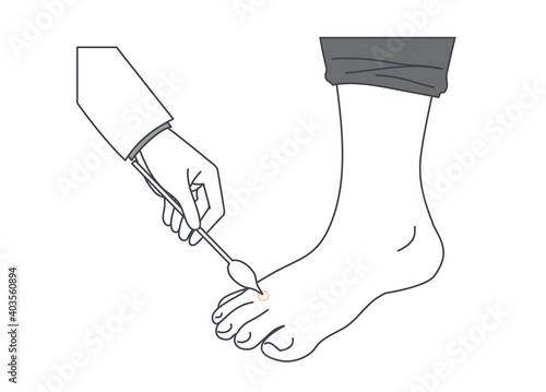 足にできたイボを治療するイラスト