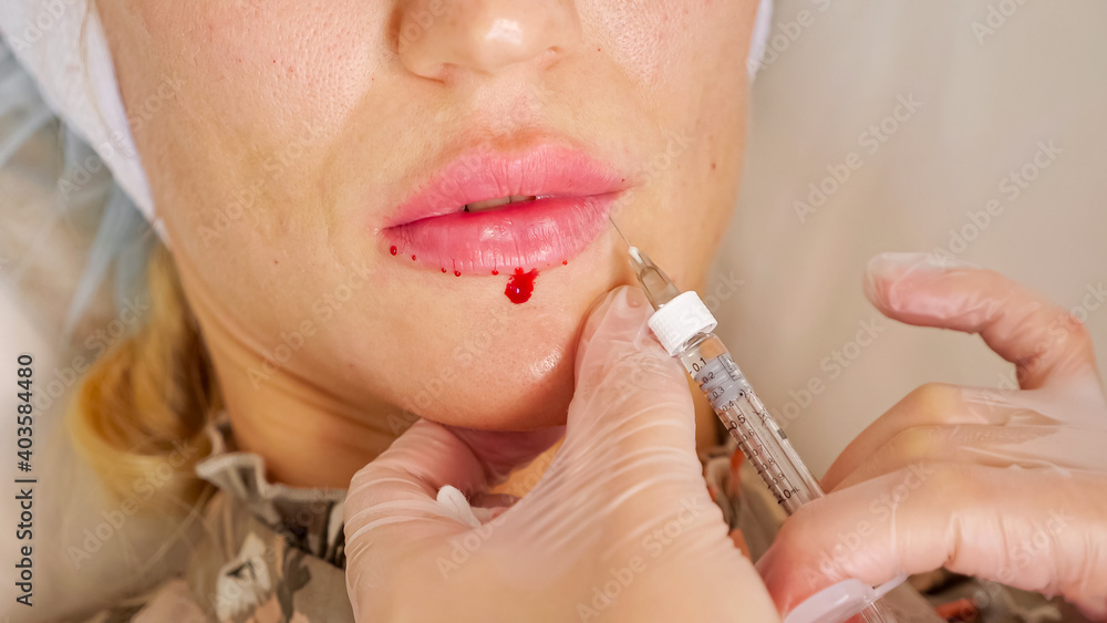 Professional cosmetic surgeon injects mature woman lips and blood appears during augmentation operation under electric light extreme closeup