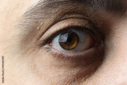 Macro brown male eye. The last stage of keratoconus. Critical stage of keratoconus. Eye disease