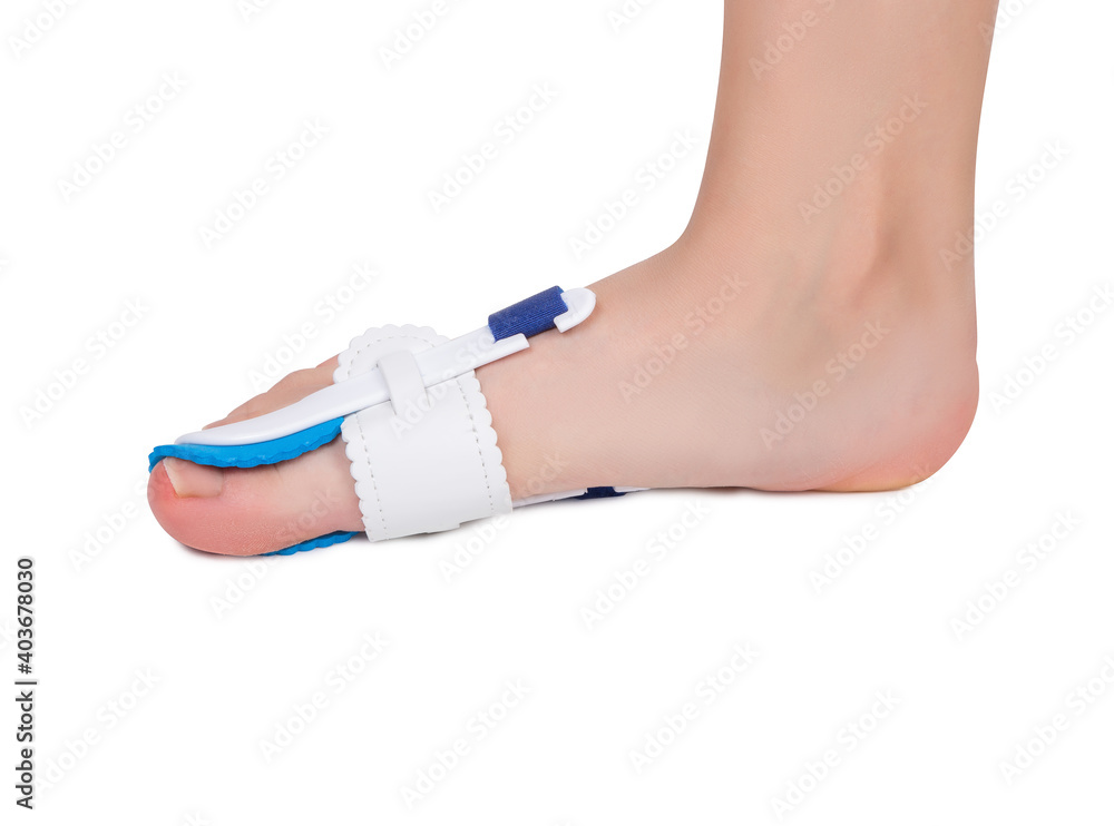 Special medical orthopedic bandage to nonsurgical treatment of a thumb deformity also known as Hallux Valgus.
Special medical orthopedic bandage to nonsurgical treatment of a thumb deformity also known as Hallux Valgus.