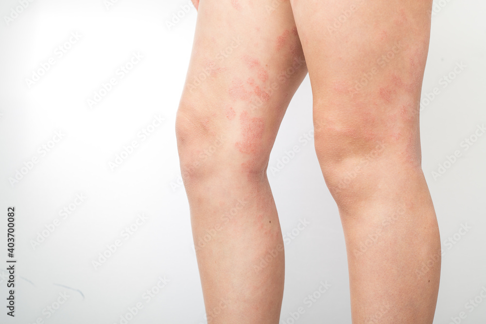 Acute atopic dermatitis on the feet of a child is a dermatological skin  disease. Large, red, inflamed, scaly rash on the legs. Legs of a teenager  with severe atopic eczema. Photos
