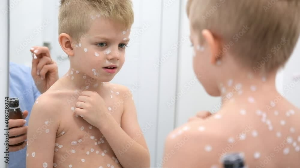 Mother applying antiseptic cream onto son skin. Varicella virus or Chickenpox bubble rash on child Mother applying antiseptic cream onto son skin. Varicella virus or Chickenpox bubble rash on child