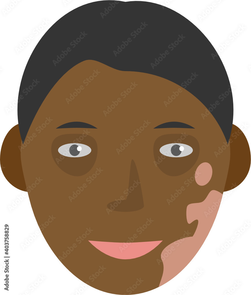 Human face with pigment birthmark short hair vector graphic clipart illustration or icon isolated Human face with pigment birthmark short hair vector graphic clipart illustration or icon isolated