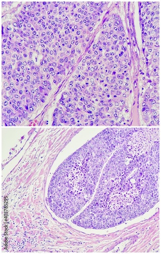 Photo of hepatocellular carcinoma reveals thick hepatic cord pattern in the upper and vascular invasion in the lower