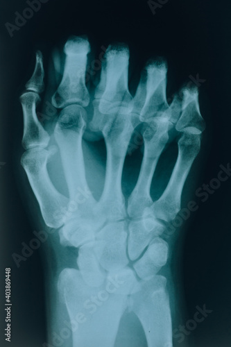 X-ray of the fist. Hand bones. Diseases and injuries of human bones