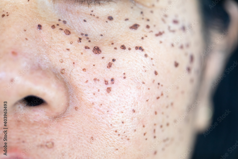 Fototapeta premium Backgrounds of lesions skin caused by acne on the face in the clinic. 