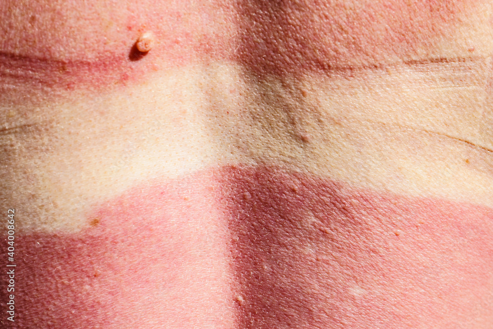 Fototapeta premium Woman back skin hurt from sun burn.