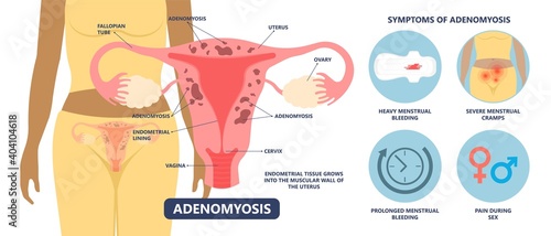 Adenomyosis pain cancer heavy disease disorder uterine surgery tissue cycle enlarged bigger abdomen female menses profuse polyp medical reproduction photo