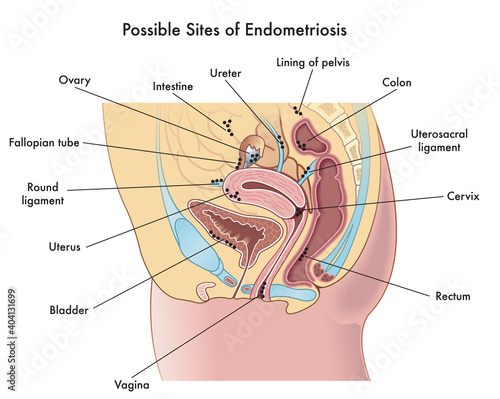 Medical illustration shows possible sites in the woman's body where endometriosisis could develop, with annotations.