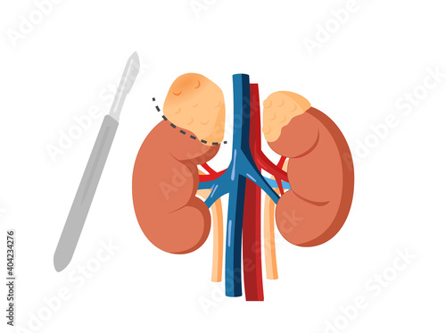 Adrenal adenoma removal. Cancer operation concept. photo