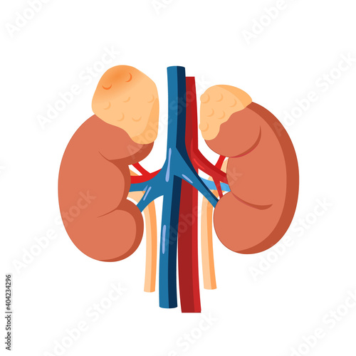Adrenal tumor vector illustration. Illustration of the healthy adrenal gland and adrenal mass