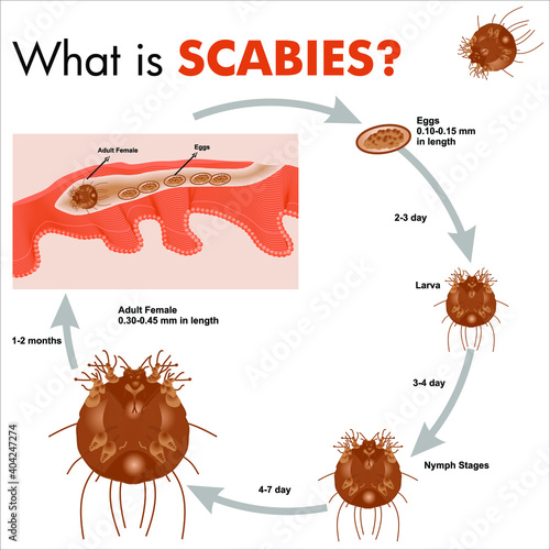 Scabies, What is Scabies photo