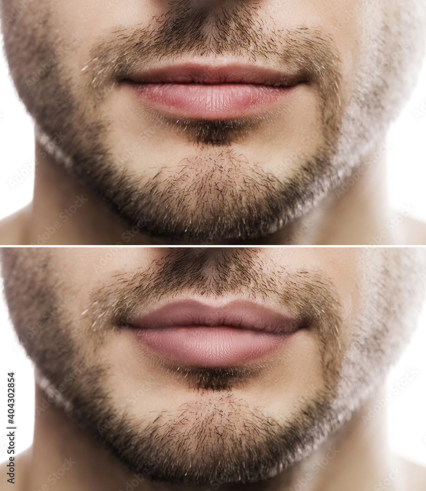 Lip augmentation. Male lips  before and after filler injection. - obrazy, fototapety, plakaty 