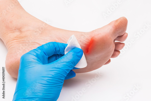 Doctor's hand in a protective medical glove applies a cotton pad to the wound on the foot, woman's leg on a white background, close-up photo