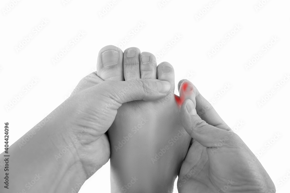Foto Ingrown toenails on a woman's foot, isolated on white background, pain in the pi