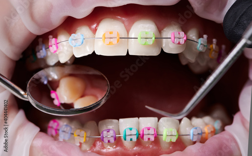 Macro snapshot of open mouth, teeth, ceramic braces with colorful rubber bands on them, latex cheek retractor on lips. Dentist checking teeth with mirror and dental explorer. Concept of orthodontics photo