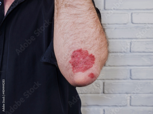 Psoriasis. Autoimmune genetic disease. A man with sore hands, dry flaky skin on his arm with psoriasis vulgaris, eczema. A large, red, inflamed, scaly rash on the elbows, a dermatological skin disorde photo