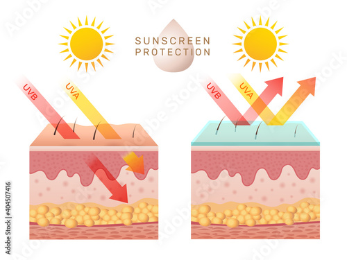 Uv skin protection. Damaged human skin peels before and after sun protection body adipose layers epidermis recent vector infographic template. Uv sunburn, ultraviolet to body damage illustration photo