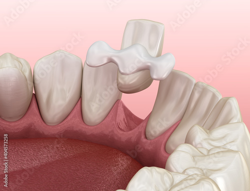 Wallpaper Mural Maryland bridge made from ceramic, frontal tooth recovery. Medically accurate 3D illustration of dental concept Torontodigital.ca