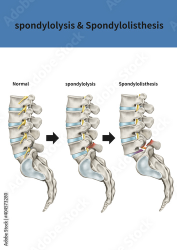척추분리증과 전방전위증 메디컬일러스트 photo